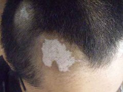 Can Vitiligo be Cured in Early Stages