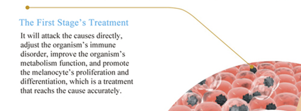 The principles to treat early vitiligo