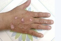 Does Skin Disease Relate to the Genes