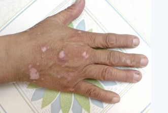 Does skin disease relate to the genes