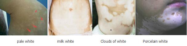 Degree of Vitiligo 