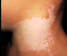 Does Vitiligo Can be Cured