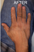 New Findings about Vitiligo