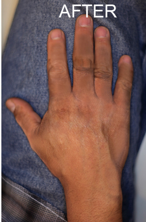 New findings about vitiligo