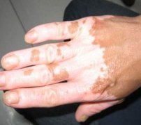 Why Vitiligo On The Edge Of the Limb Is Har