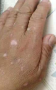 The Factors can Induce Vitiligo