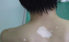 What are the Features of Vitiligo