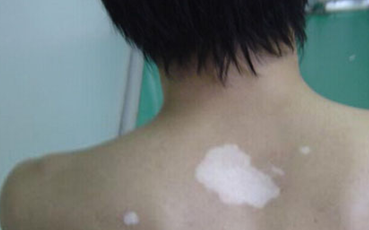 What are the features of vitiligo