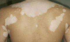 What are Factors Can Cause Vitiligo