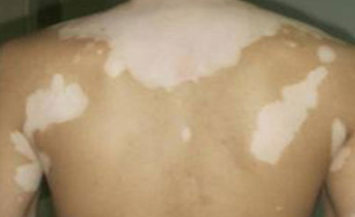 What are the factors can cause vitiligo