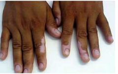 What are the Nagative Impacts of Vitiligo