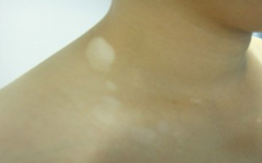 How to Diagnose it as Vitiligo?