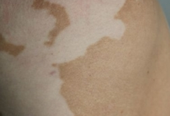 What are Factors Cause Vitiligo Rebounding 