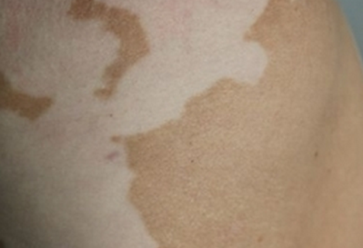 What are factors cause vitiligo rebouding again 