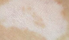 What are Symptoms for Early Stage Vitiligo?