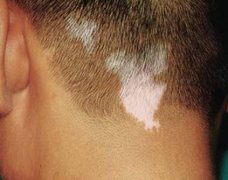 Why Vitiligo Easily to Rebound Again?