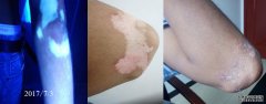 What Kind of Disease for Vitiligo