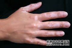 Is Vitiligo A Contagious Disease