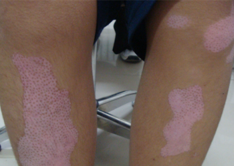 vitiligo treatment 