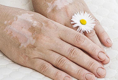 Why Some Vitiligo is Easy to Treat and Some