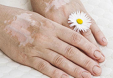 vitiligo treatment