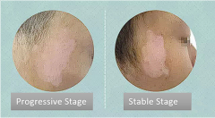 The Differences Between Progressive stage V