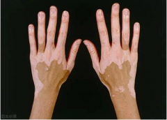 Why Does Some Vitiligo Shows Symmetrical Di