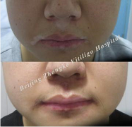 Can Mucosal Type of Vitiligo Such as Lips b