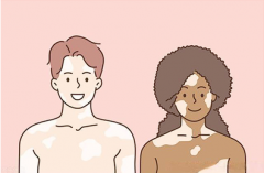 The Relationship Between Vitiligo and Gende