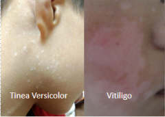 The Difference Between Vitiligo and Tinea V