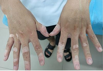 vitiligo hand