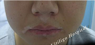 vitiligo lip