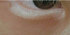 Does Vitiligo Affect Your Eyesight?