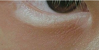 Vitiligo eye eyesight