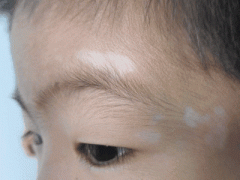 Vitiligo in Children