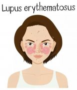 Is There a Relationship between Lupus Eryth