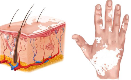 vitiligo treatment