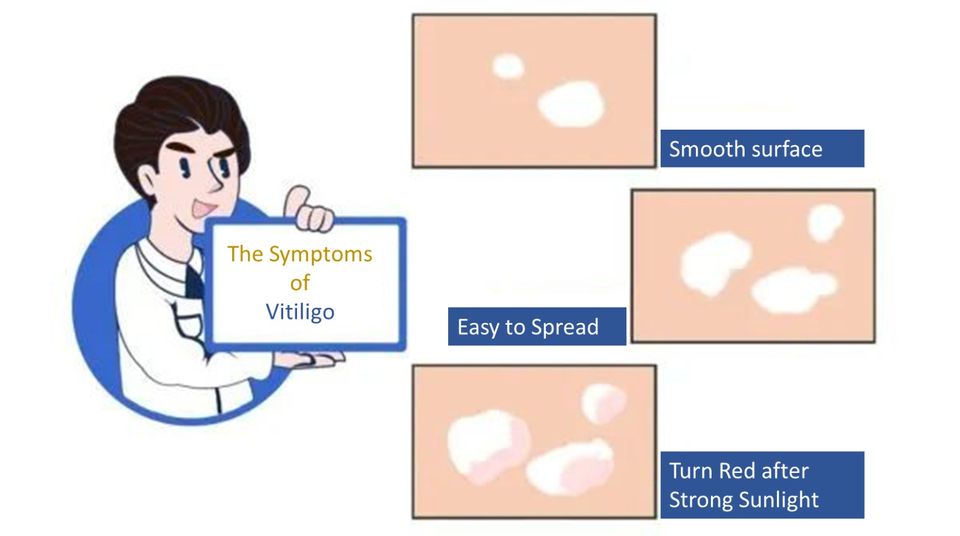 vitiligo symptom