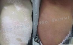 How does Vitiligo Patient Avoid Isomorphic 