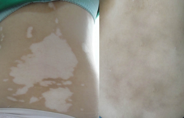 Where Does Vitiligo Occur Most Often in the Body?