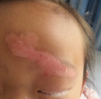 Is Anaemic Nevus Caused by Anaemia ? How to Distinguish It from Vitiligo