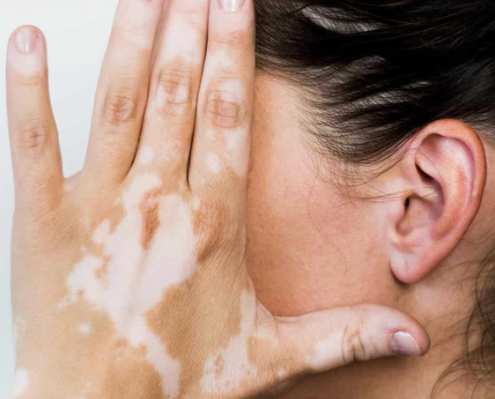 Is the onset of vitiligo related to age and gender?