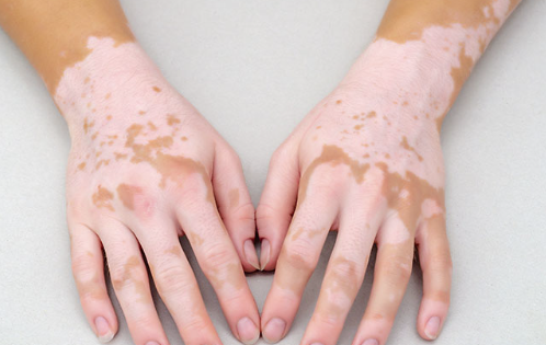 Not as good as expected, how long will vitiligo works of drug treatment?