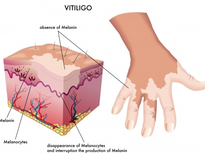 What are the factors that affect the treatment of vitiligo?