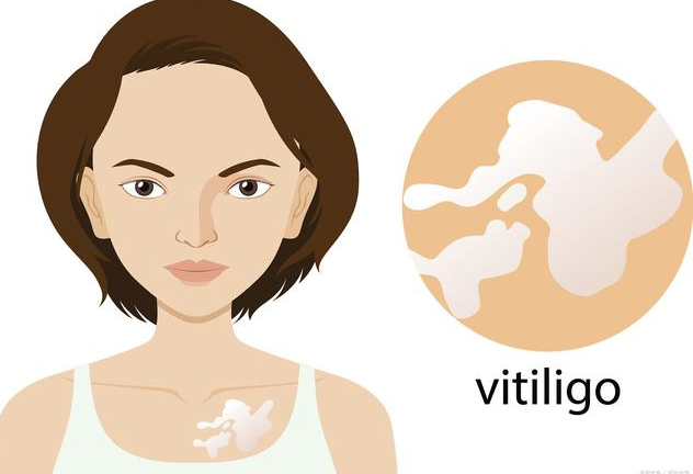 What are the indications and contraindications of vitiligo surgical treatment?