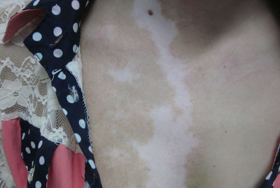 vitiligo treat