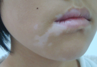 During The Period Of Vitiligo Treatment