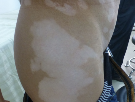 How Can People Cope With The Emotional And Psychological Aspects Of Vitiligo?