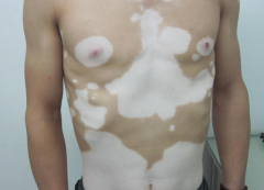 Photochemical Therapy to Treat Vitiligo