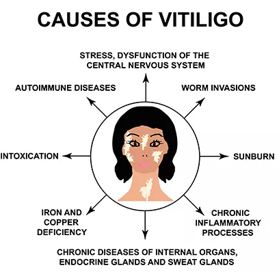 vitiligo causes